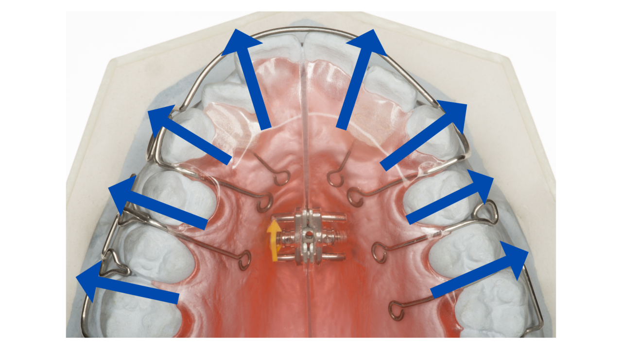 拡大床をつかった矯正-旭川市芦別市 矯正歯科相談室