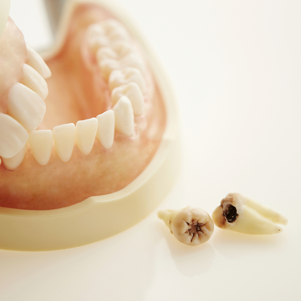 小児矯正すれば子供は虫歯にかかりにくい - 芦別矯正歯科相談室（旭川・富良野・赤平）