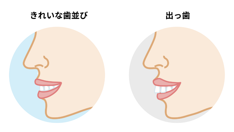出っ歯とは-旭川市芦別市 矯正歯科相談室