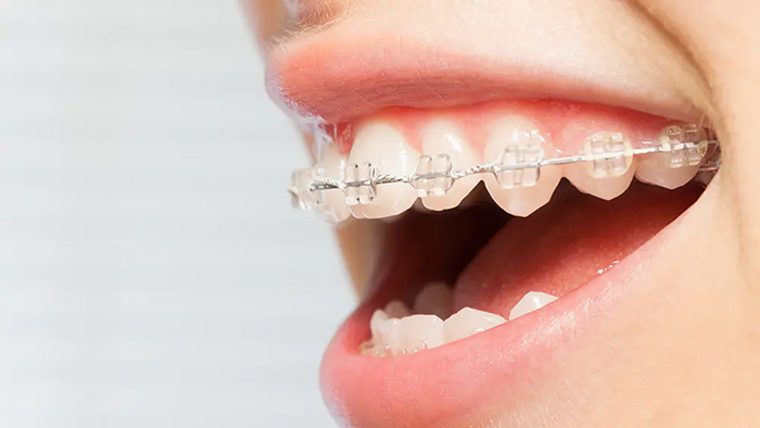 ワイヤー矯正- 芦別矯正歯科相談室（旭川・富良野・赤平）