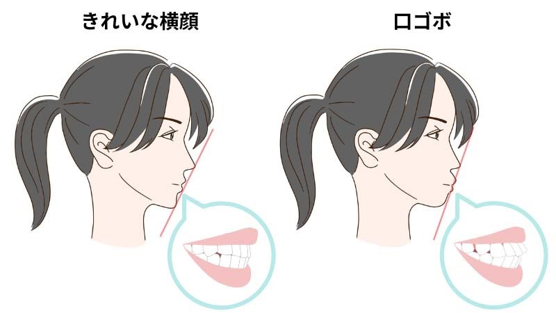 きれいな横顔と口ゴボ-旭川市芦別市 矯正歯科相談室