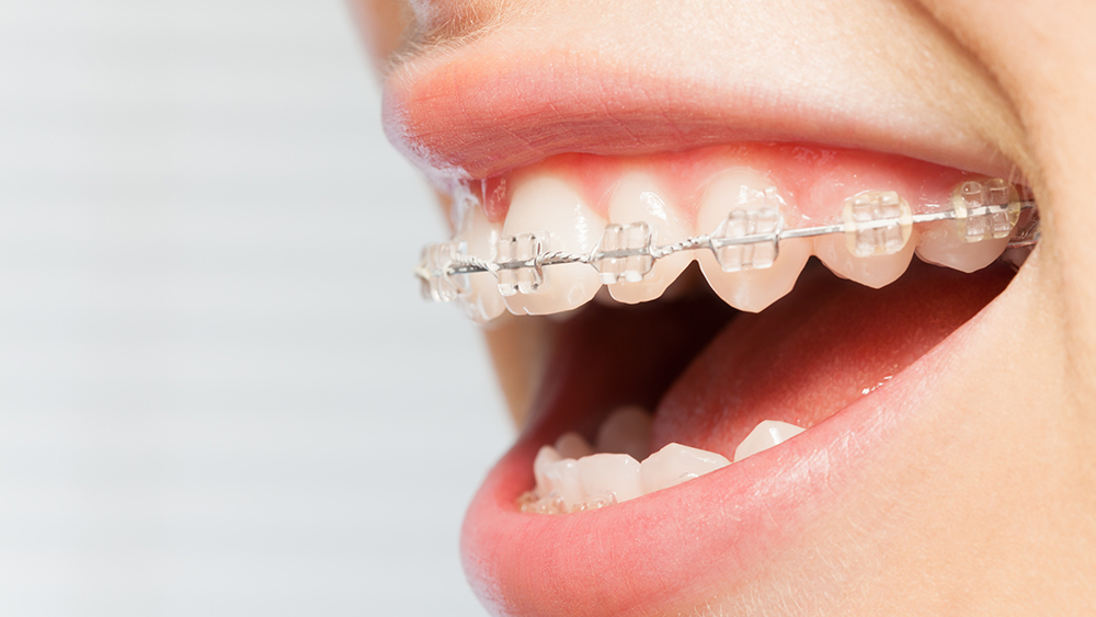 ワイヤー矯正- 芦別矯正歯科相談室（旭川・富良野・赤平）