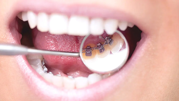 裏側矯正- 芦別矯正歯科相談室（旭川・富良野・赤平）