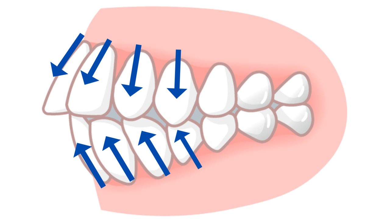 歯を抜かない矯正-旭川市芦別市 矯正歯科相談室