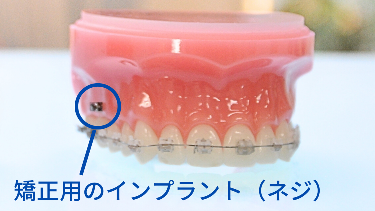 インプラント矯正- 芦別矯正歯科相談室（旭川・富良野・赤平）