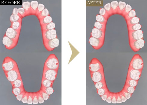 20代女性出っ歯・ガタガタ- 芦別矯正歯科相談室（旭川・富良野・赤平）