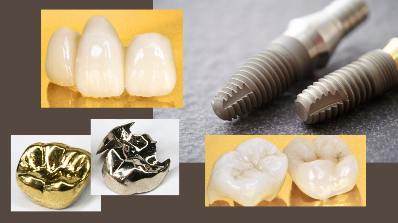 差し歯やブリッジがあっても治療可能-旭川市芦別市 矯正歯科相談室